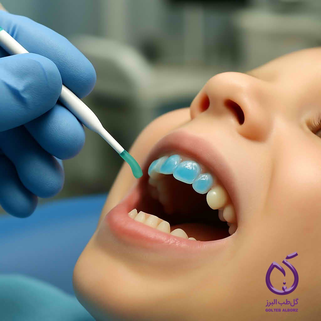 فلوراید تراپی در دندانپزشکی