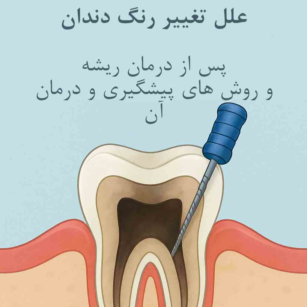 علت تغییر رنگ دندان بعد از عصب‌کشی | درمان تیرگی و سفید کردن دندان