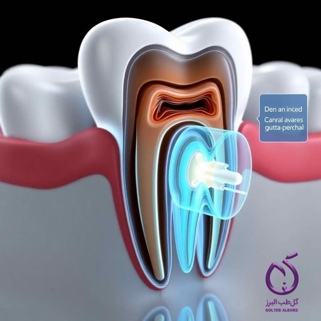 آبچوریشن کانال های دندان