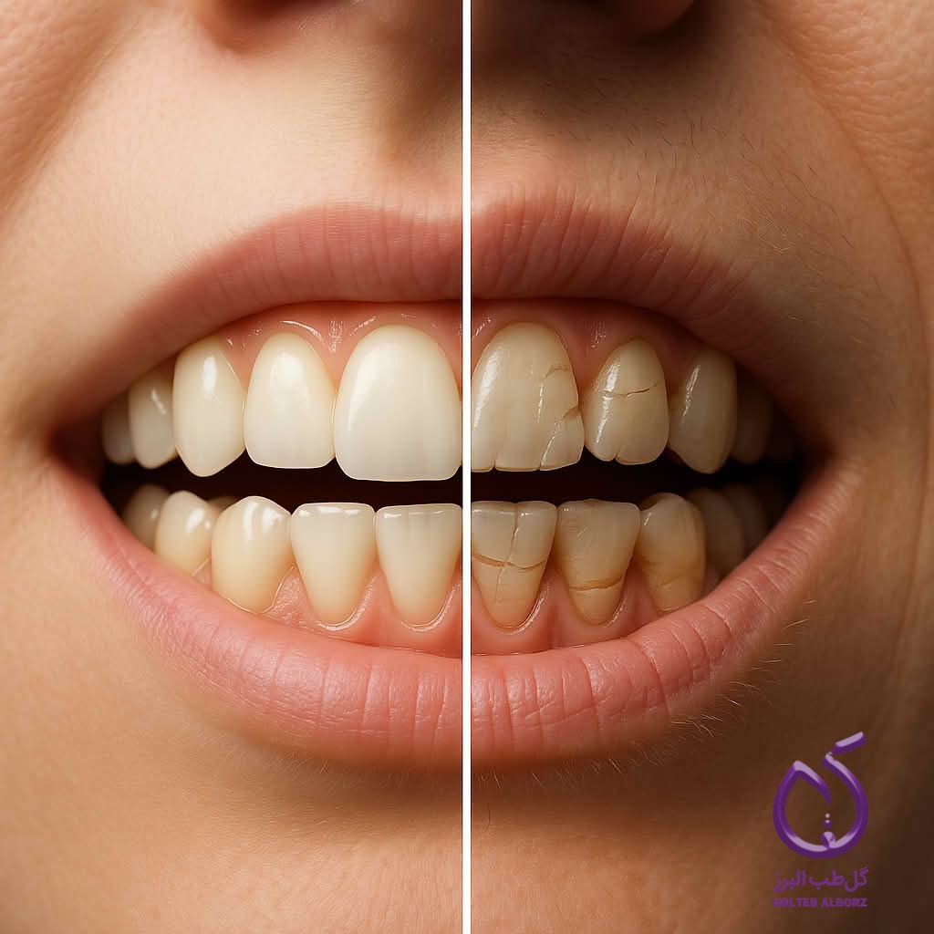 تاثیرات کووید 19 یا کرونا بر شیوع اختلالات گیجگهاهی فکی (TMDs) و دندان قروچه