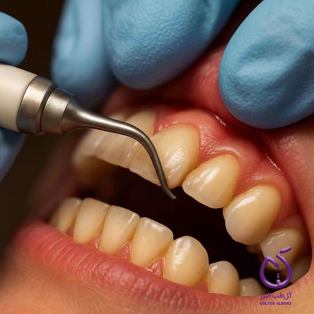 بیماری‌های لثه: علل، علائم و روش‌های درمان بیماری‌های پریودنتال