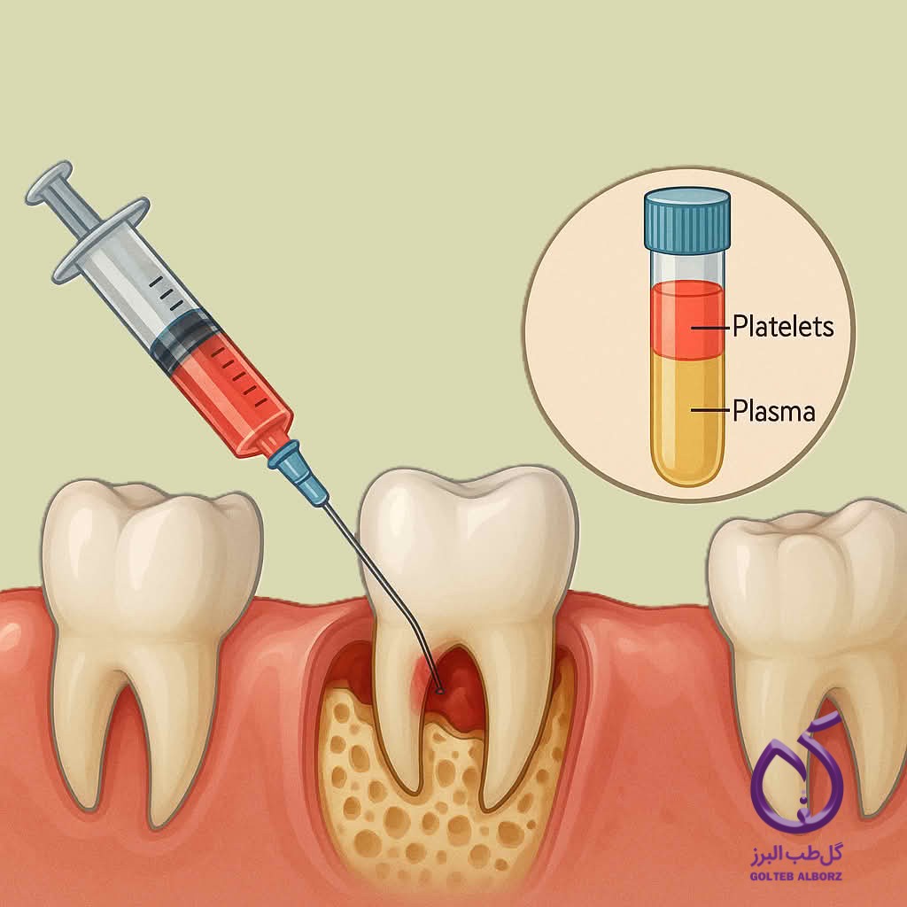 تصویرسازی کاربرد PRP (پلاسما غنی از پلاکت) در جراحی دندان&zwnj;پزشکی که تزریق نزدیک ریشه دندان و یک لوله آزمایش نشاندار شده حاوی پلاسما و پلاکت&zwnj;ها را نشان می&zwnj;دهد و نقش آن را در بازسازی استخوان و بافت برجسته می&zwnj;کند.          Ask ChatGPTتصویرسازی کاربرد PRP (پلاسما غنی از پلاکت) در جراحی دندان&zwnj;پزشکی که تزریق نزدیک ریشه دندان و یک لوله آزمایش نشاندار شده حاوی پلاسما و پلاکت&zwnj;ها را نشان می&zwnj;دهد و نقش آن را در بازسازی استخوان و بافت برجسته می&zwnj;کند.