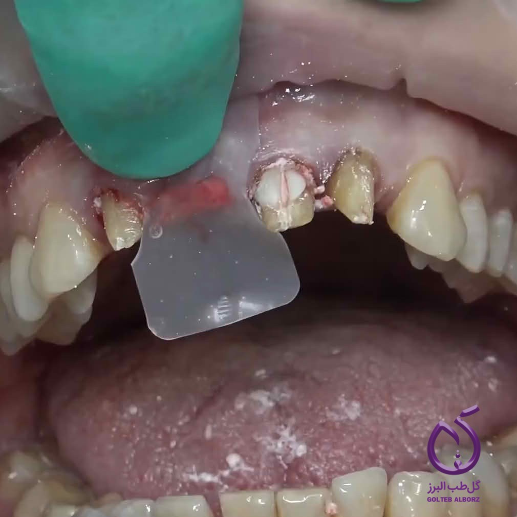 speed-up-tooth-socket-healing-with-ora-aid-oral-dressings