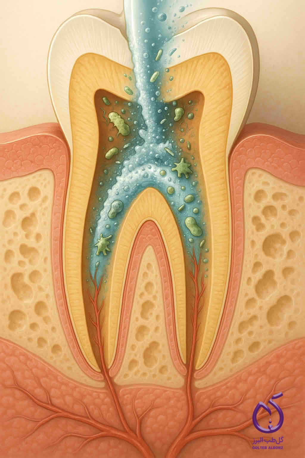 شستشوی کانال ریشه و حذف دبری ها از کانال ریشه دندان