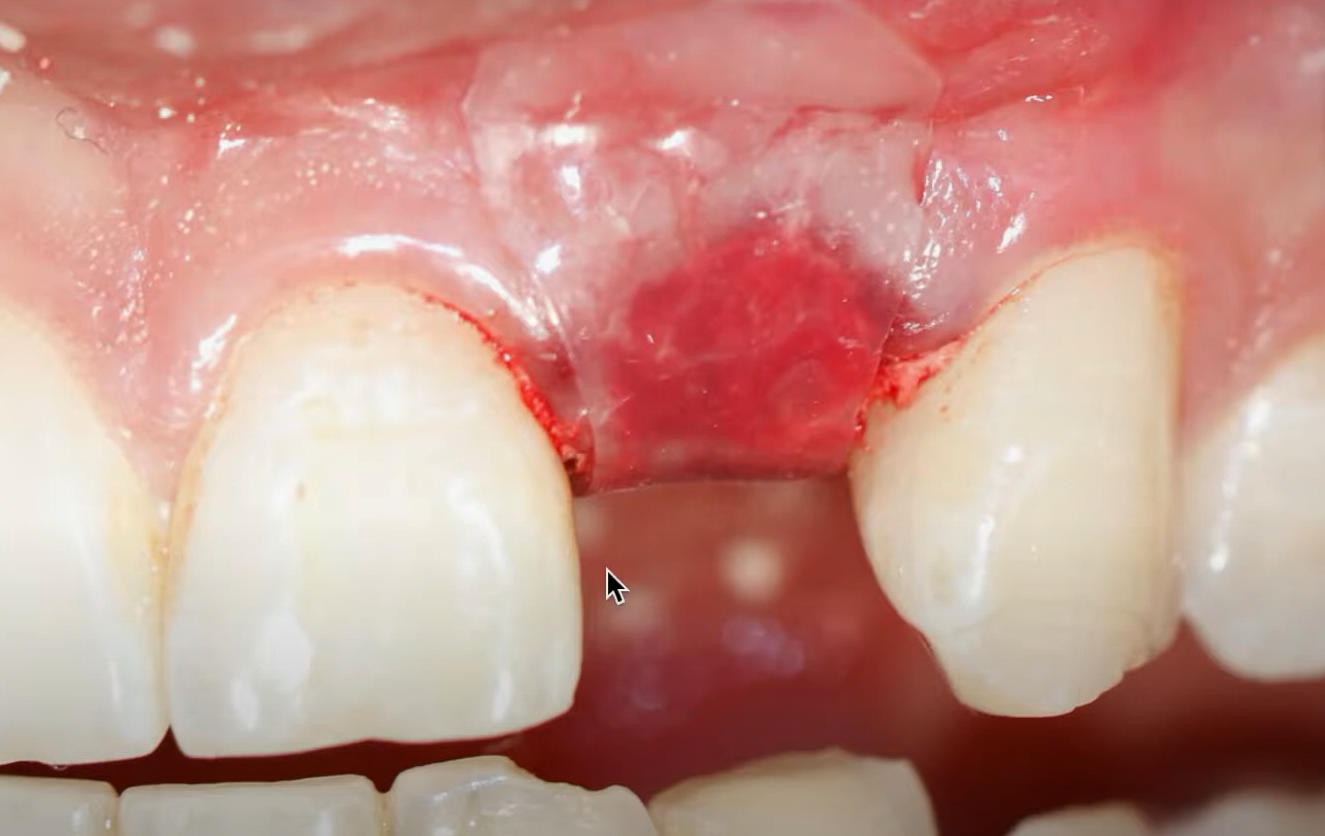 کاربرد چسپ های داخل دهانی اوراید (Ora-Aid) در دندان کشیدن